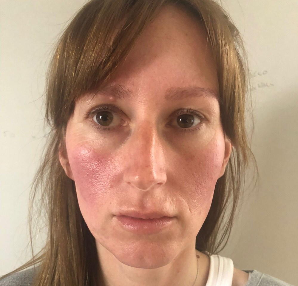 Rosacea, Me and PRP; How Platelet Rich Plasma Therapy Helped My Skin and My Confidence
